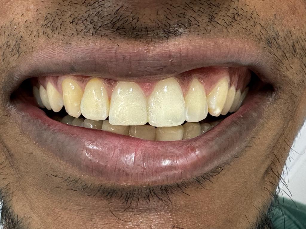 Aesthetic reshaping after treatment